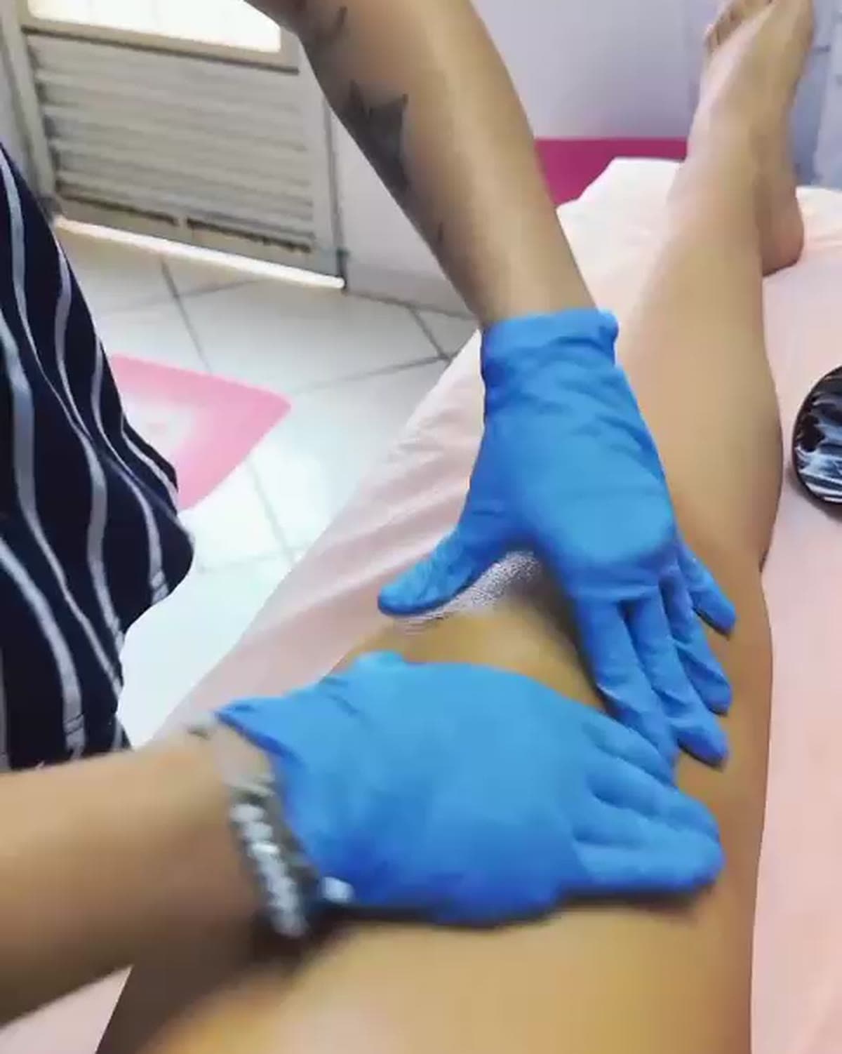 Atendimento de lipedema nas pernas.